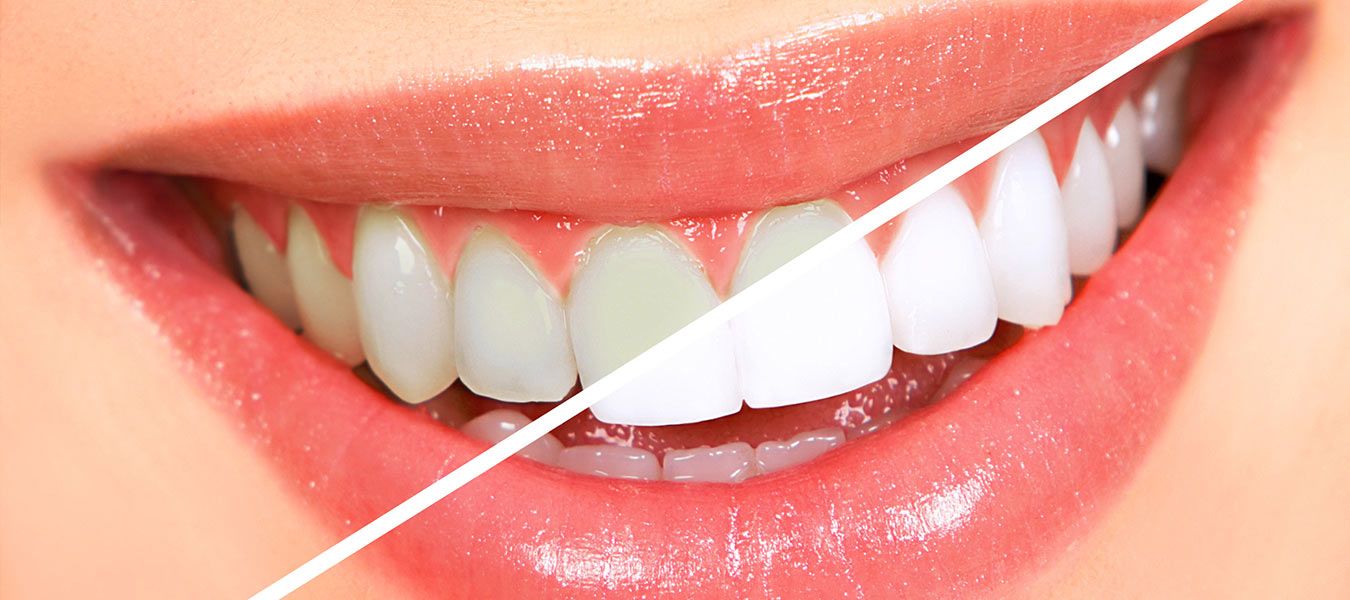 Виды и способы установки зубных накладок на зубы